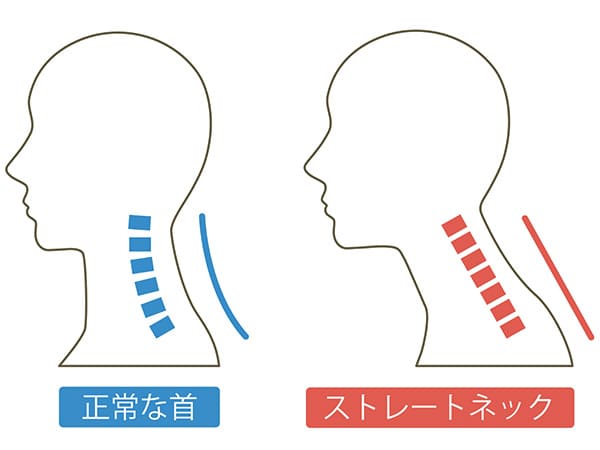 ストレートネックのイラスト